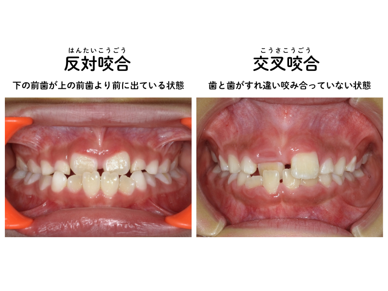 矯正治療のゴールを考える - コラム - 東海市のきらめきデンタルクリニック